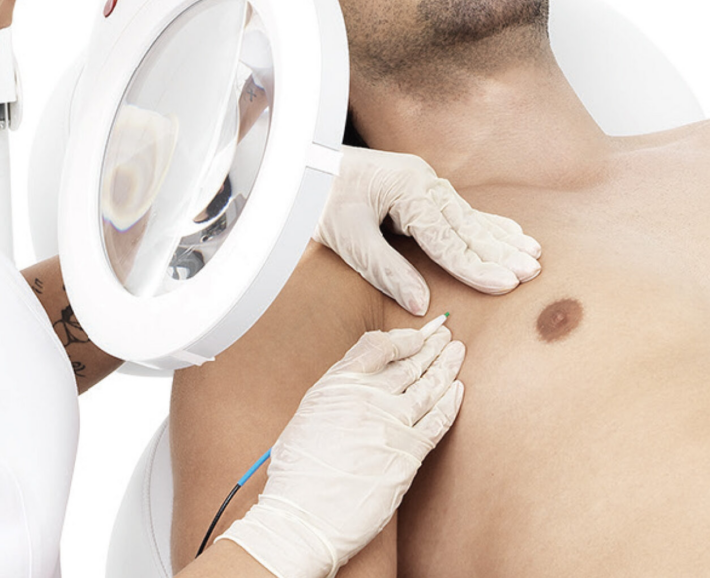 épilation électrique sur torse d'homme